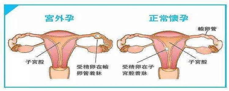 宫外孕是什么原因造成的